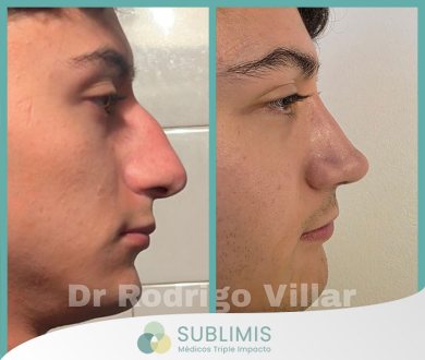 Rinoplastia Correctiva
