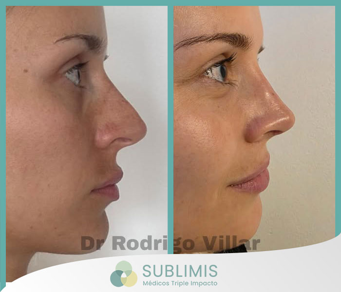 Rinoplastia Estética