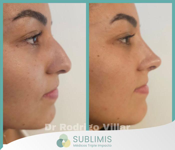 Rinoplastia Estética