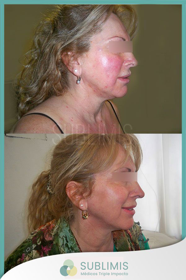 Antes y después de un tratamiento para la rosacea con plasma rico en plaquetas. Foto de perfil de mujer de 55 años.