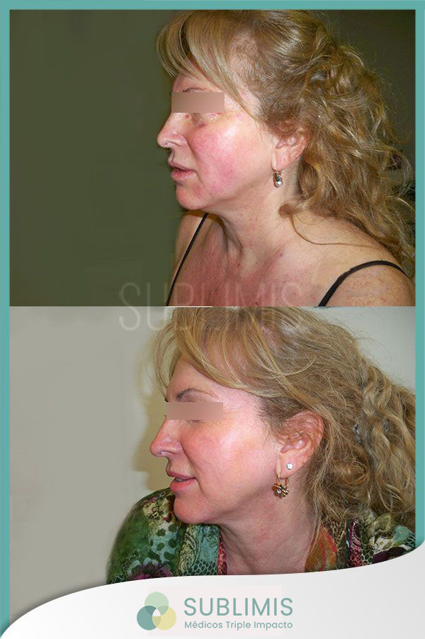 Antes y después de un tratamiento para la rosacea con plasma rico en plaquetas. Foto de perfil derecho de mujer de 55 años.
