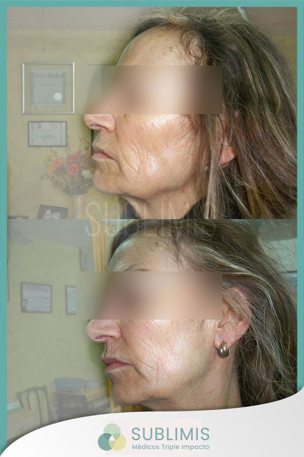 Before and after a thread lift. Pictures of the profile view.