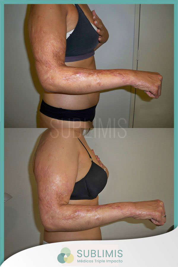 Treatment for burns, before and after