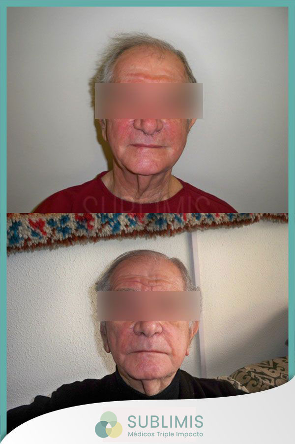 Platelet Rich Plasma for Rosacea