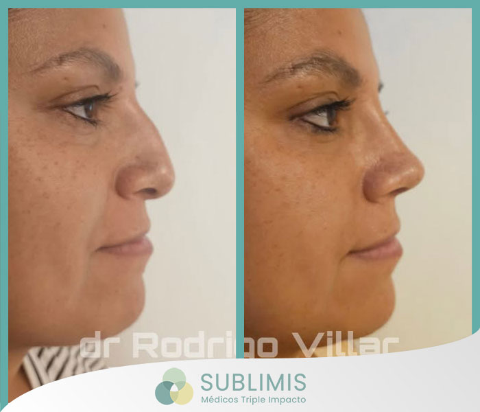 Fotos de antes y despues de una cirugia de nariz Fotos de antes y despues de una cirugia de nariz