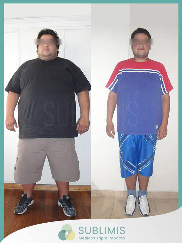 Antes y despues de una cirugia de bypass gastrico Antes y despues de una cirugia de bypass gastrico