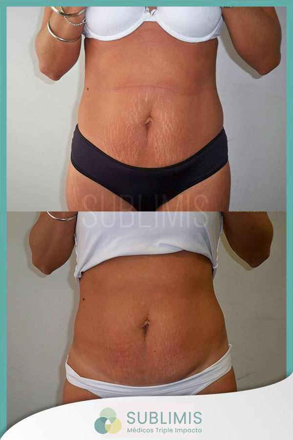 Antes y despues de un tratamiento para las estrias