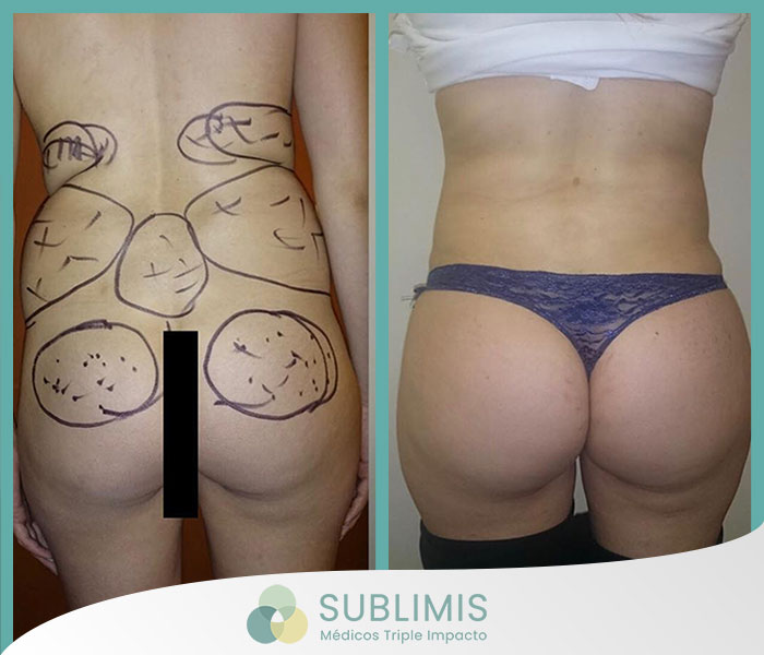 Antes y después de un aumento de glúteos.