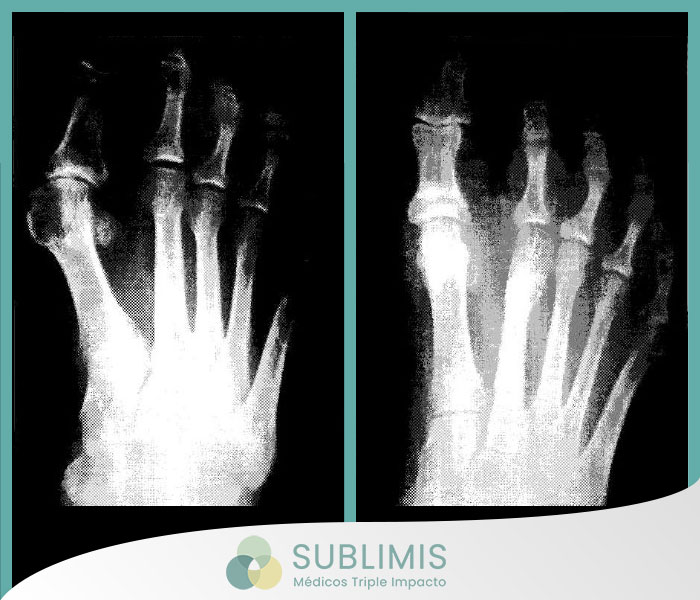 Foto de antes y despues de una cirugia de juanetes