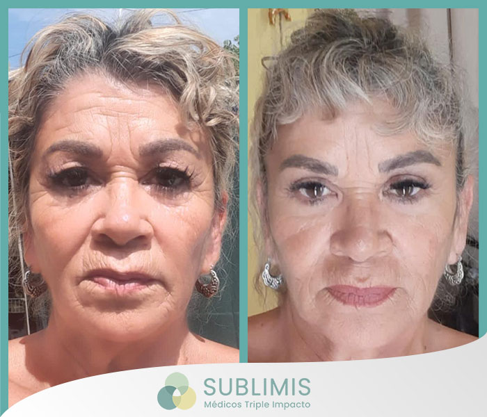 Before and after a blepharoplasty.