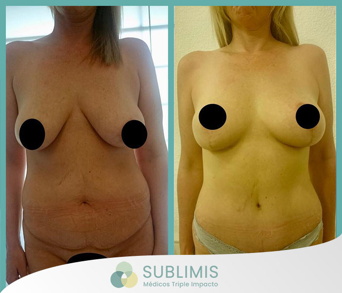 Before and after a Breast Lift.