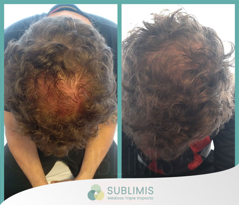 Fotos de un hombre de 45 años antes y después de realizarse un tratamiento de recuperación capilar con plasma rico en plaquetas combinado con mesoterapia y péptidos biactivos.