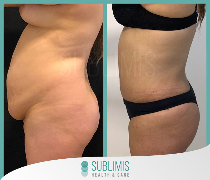 https://www.sublimis.com/img/cirugias/abdominoplastia_222.jpg