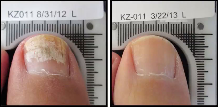 Láser para Onicomicosis Eliminá Hongos en las