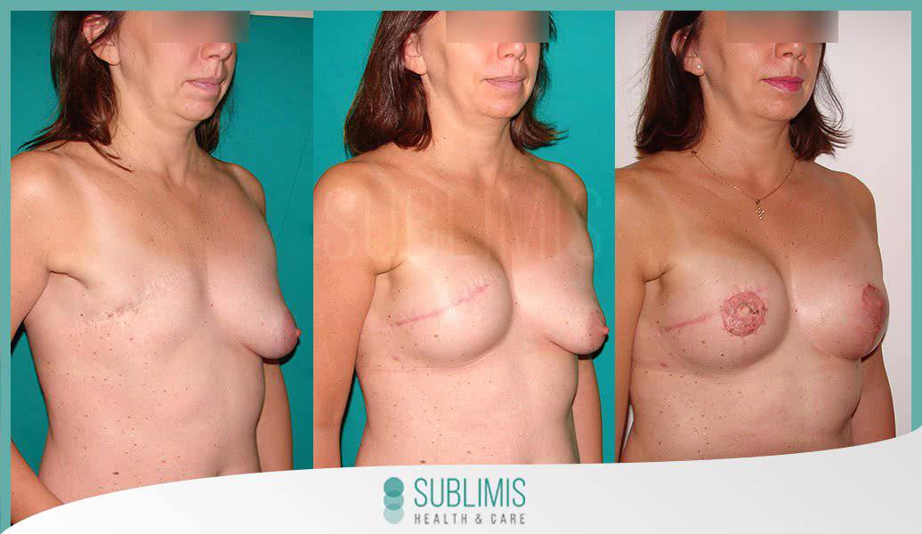 argentina augmentation breast in photo Bare naked ladies are men cd