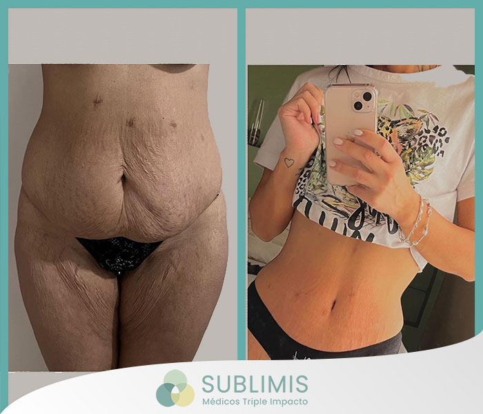 Tummy Tuck Abroad  Abdominoplasty Surgery in Argentina