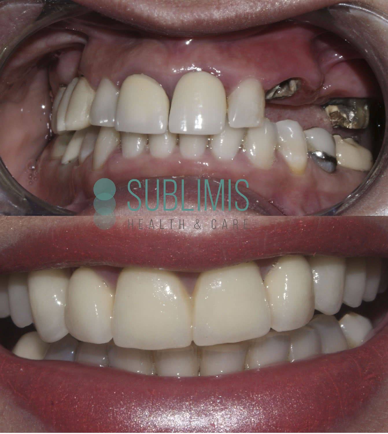 Fotos de antes y después de la colocación de implantes dentales
