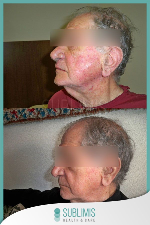 Tratamiento con plasma rico en plaquetas, antes y después.