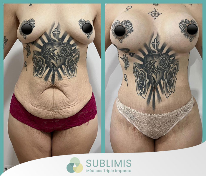 Cirugía de abdomen, antes y después