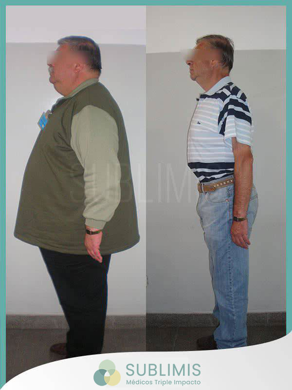 Tratamiento de la Diabetes - Cirugía Metabólica - Córdoba Tratamiento de la Diabetes - Cirugía Metabólica - Córdoba
