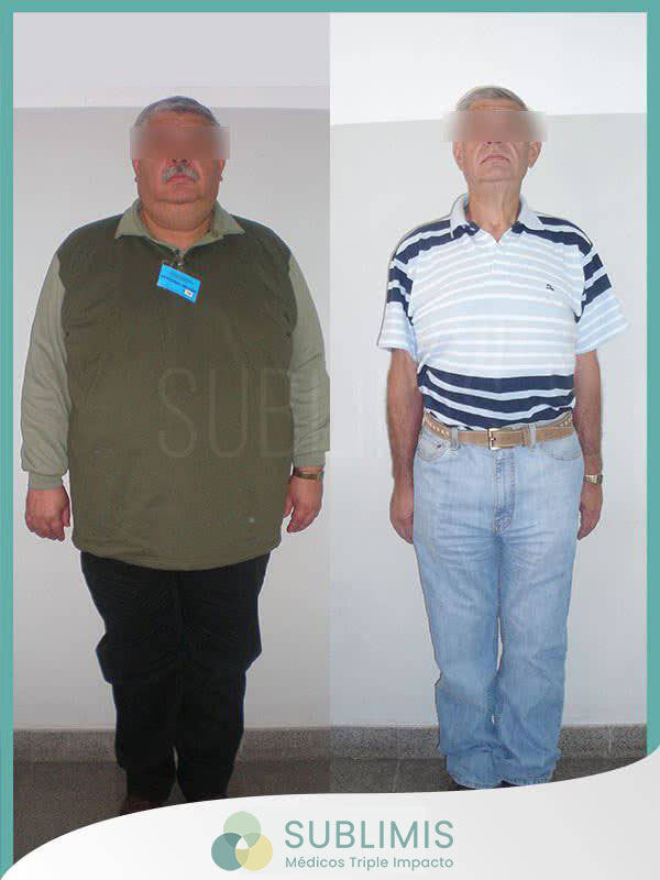 Tratamiento de la Diabetes - Cirugía Metabólica - Córdoba Tratamiento de la Diabetes - Cirugía Metabólica - Córdoba