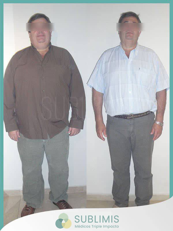Tratamiento de la Diabetes - Cirugía Metabólica - Córdoba Tratamiento de la Diabetes - Cirugía Metabólica - Córdoba