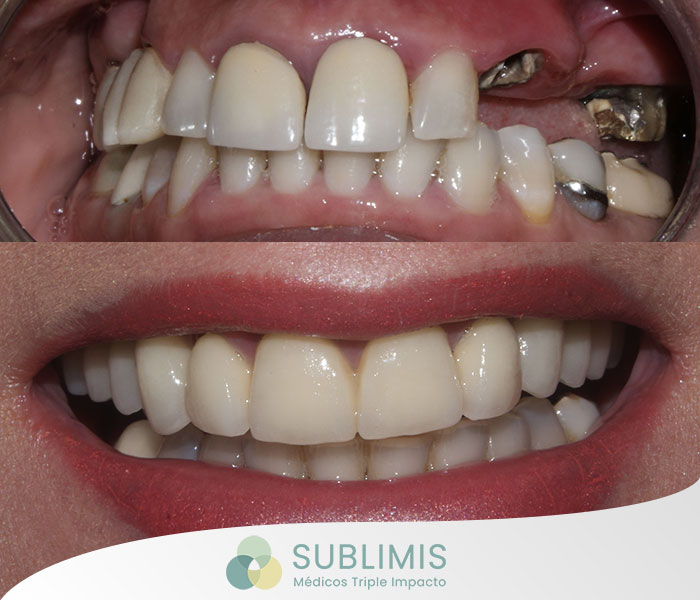 Fotos de antes y después de la colocación de implantes dentales