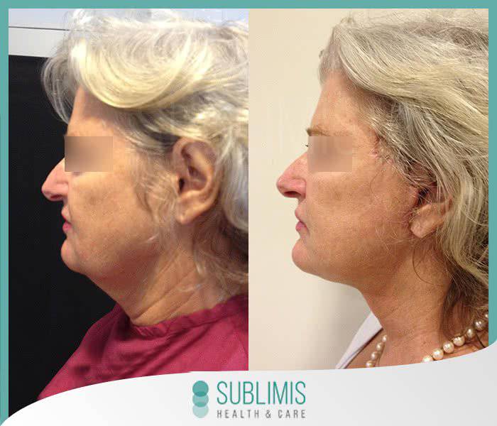 Lifting Facial Precio Cirugía Plástica Facial en Argentina