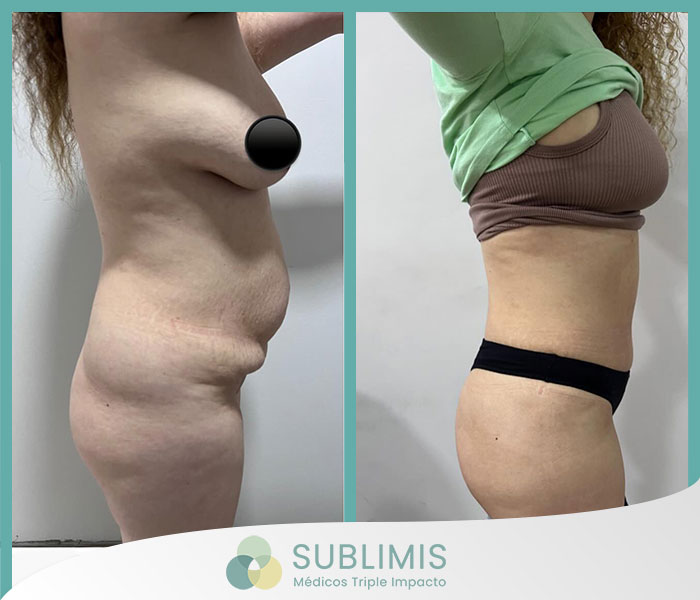 Antes y después de una liposucción
