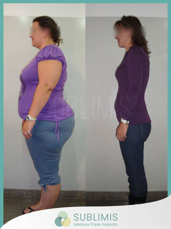 Cirugía Bariatrica Manga Gástrica Córdoba Argentina