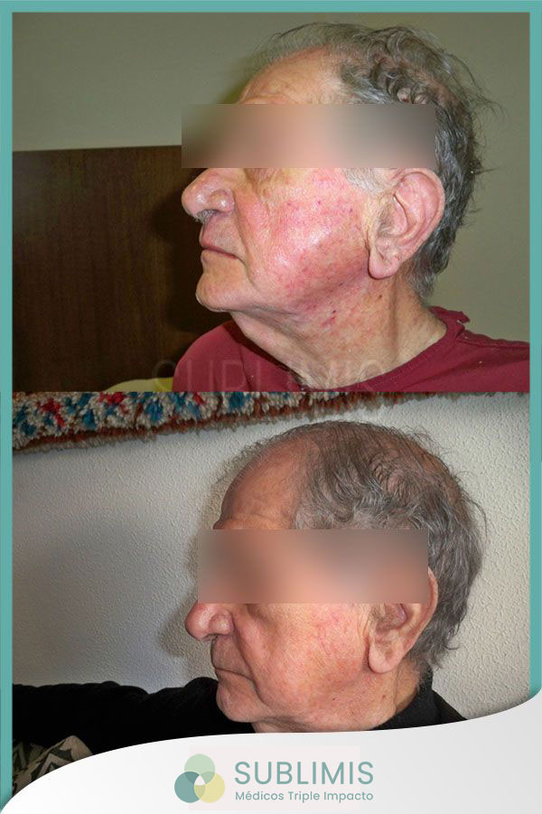 Tratamiento con plasma rico en plaquetas, antes y después.