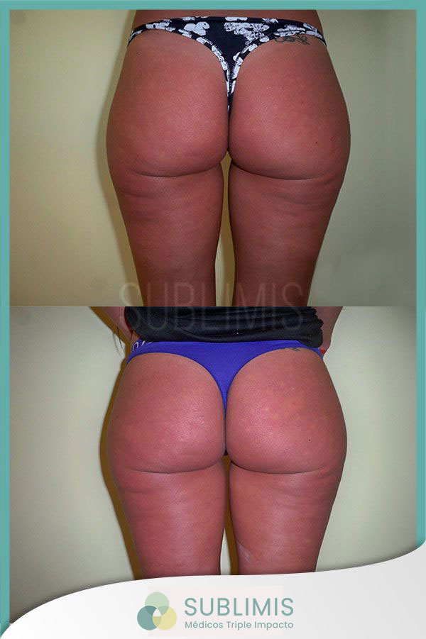 Antes y después de un tratamiento para la celulitis.