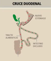 cruce duodenal