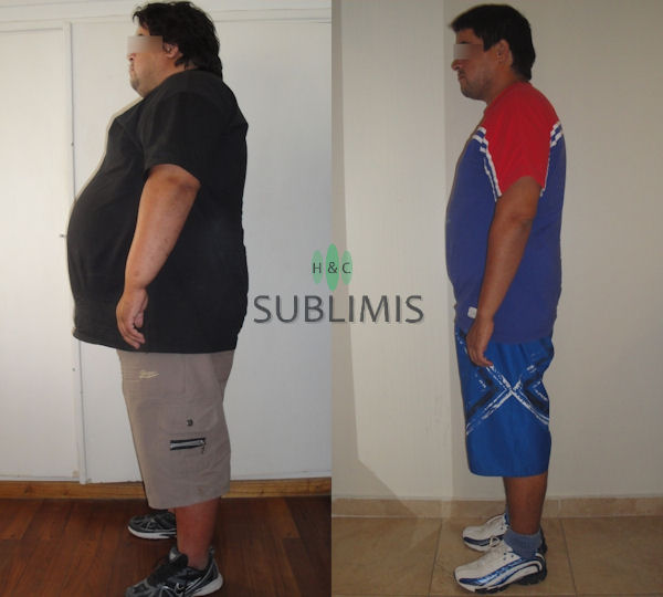 Antes y despues de una cirugia bariatrica Antes y despues de una cirugia bariatrica