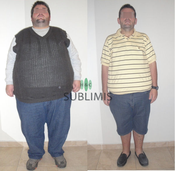 Antes y despues de la Cirugia de la Obesidad