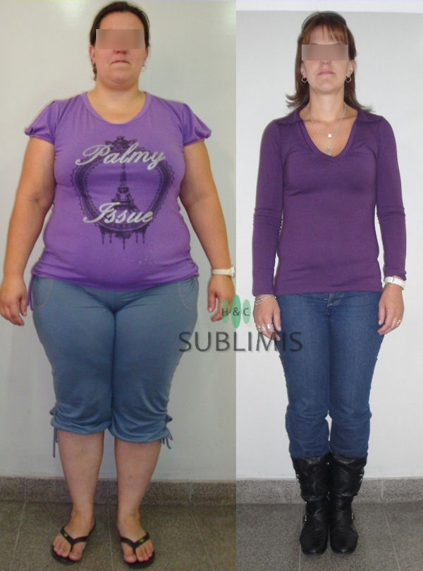 Antes y despues de una cirugia bariatrica