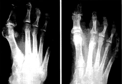 Radiografia antes y despues de una cirugia de juanetes