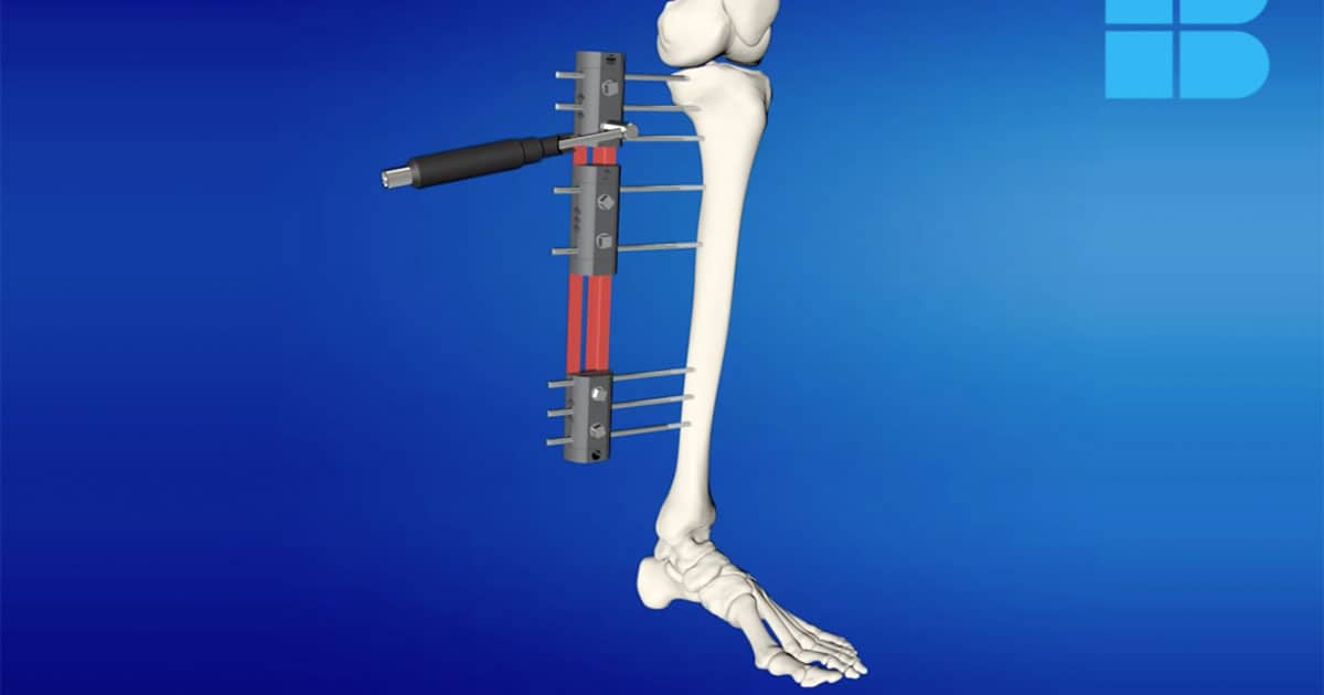 Elongación Ósea: ¿Cómo es el Tratamiento para Alargar los Huesos?