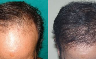 Antes y después de implantes capilares