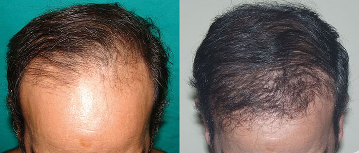 Antes y después de implantes capilares