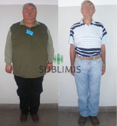 Antes y despues de una Cirugia Metabolica