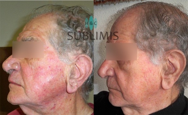 Medicina Antiedad, antes y despues de plasma rico