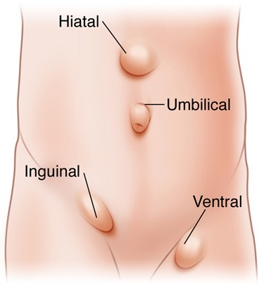 Tipos de hernias