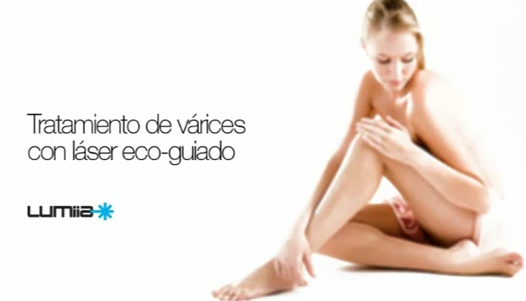 Tratamiento de varices con laser