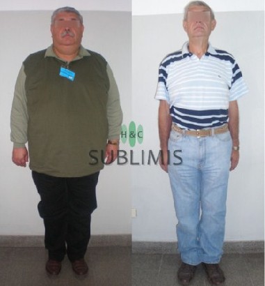 Antes y despues de una cirugia metabolica