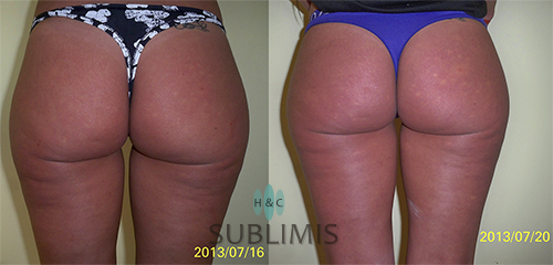 antes y despues celulitis