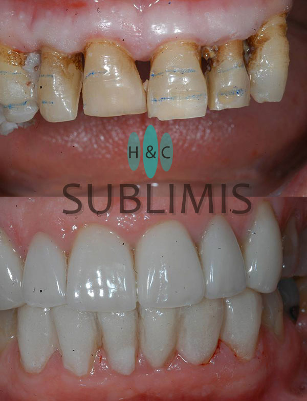 Antes y después de carillas de porcelana