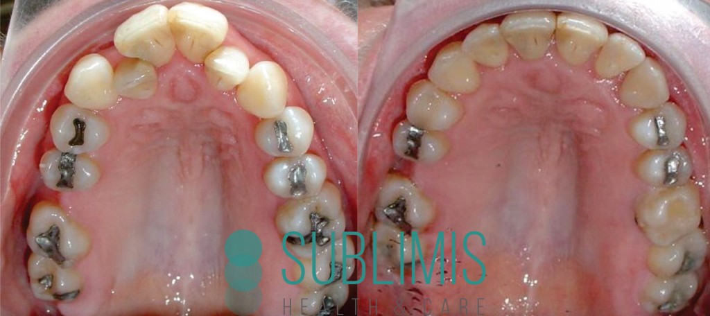 Antes y despues de ortodoncia convencional