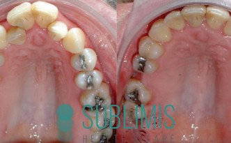 Antes y despues de ortodoncia convencional