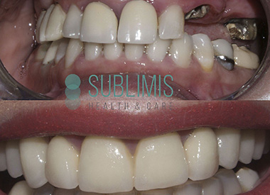 implantes dentales